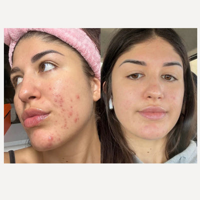 Award Winning Serum. Mukti Barrier Repair Serum Before & After Use at One Fine Secret.