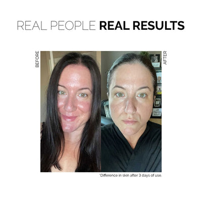 Before and after - Fitglow Beauty Redness Rescue Cream (RRC) at One Fine Secret.